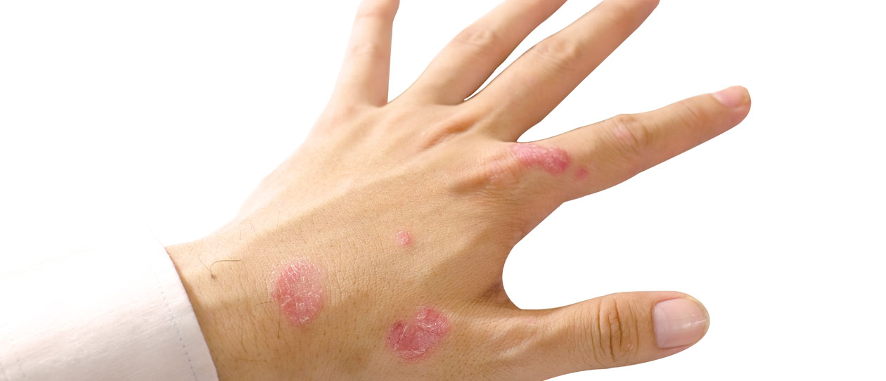 Psoriasis