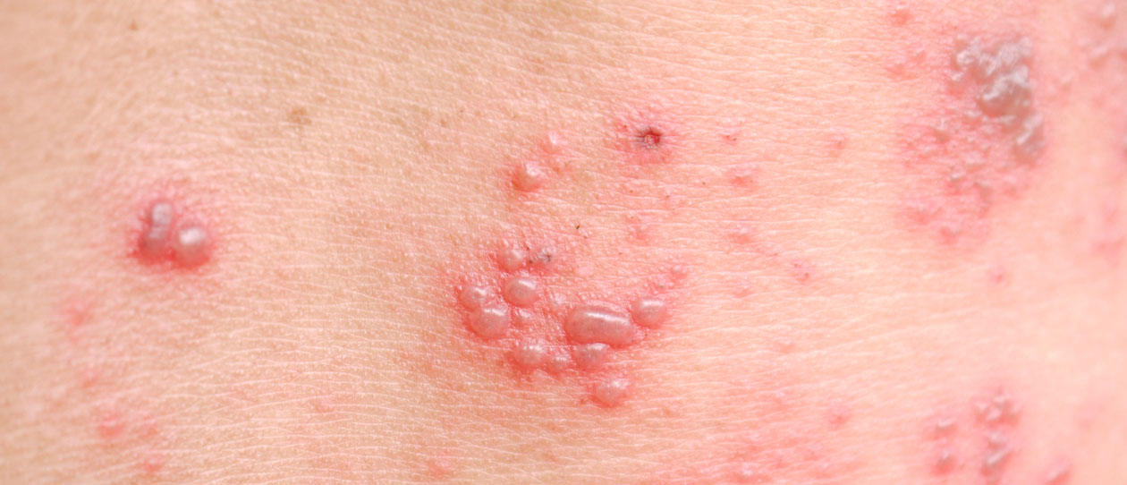 Shingles